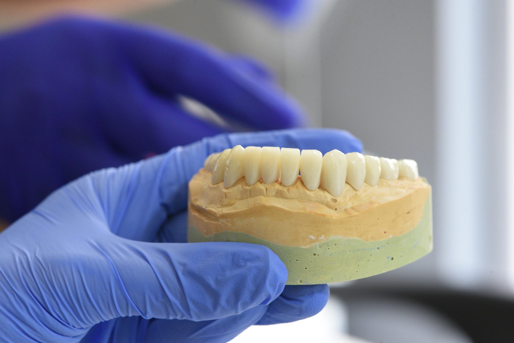 Lucrare protetică dentară la Platinum Dental, Slatina